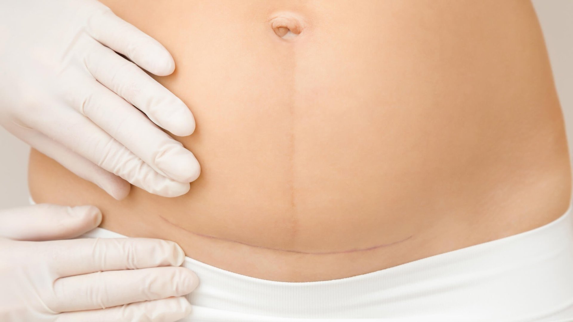 Dolores abdominales tras la cesárea: consejos para una recuperación rápida