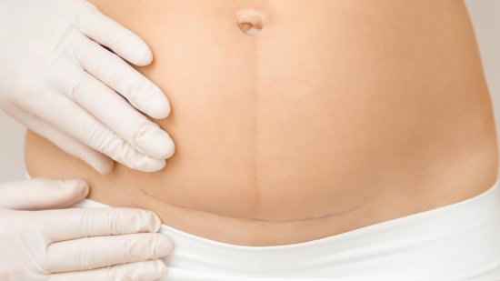 Dolores abdominales tras la cesárea: consejos para una recuperación rápida