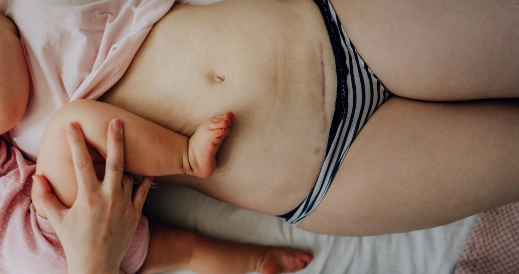Dolores abdominales tras la cesárea: consejos para una recuperación rápida