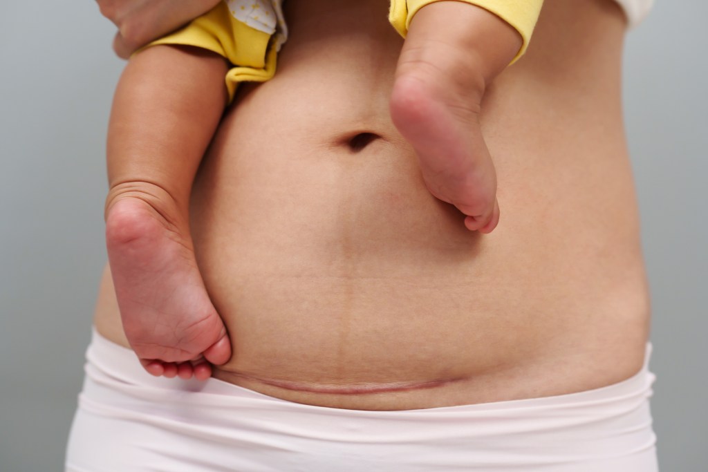 Dolores abdominales tras la cesárea: consejos para una recuperación rápida