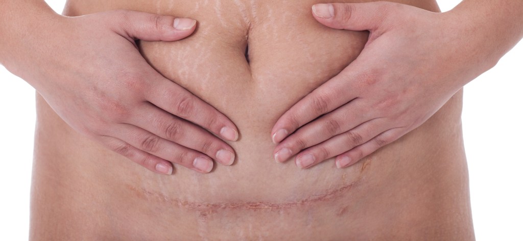Dolores abdominales tras la cesárea: consejos para una recuperación rápida