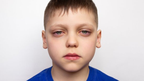 Ojeras en niños: cuáles son las causas más comunes
