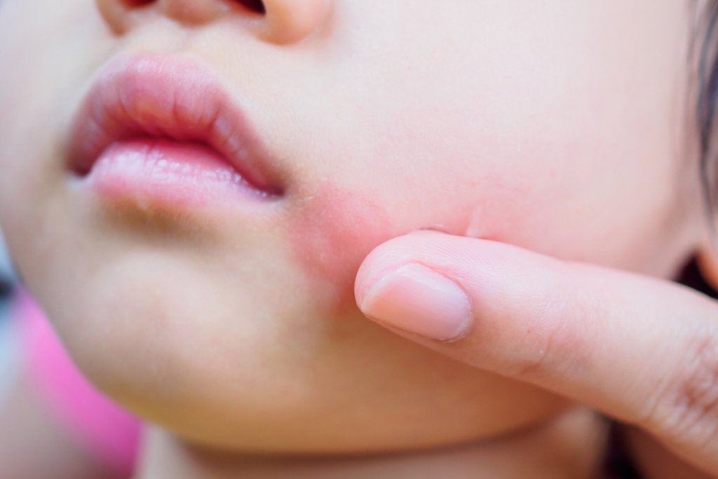 Herpes labial y nasal, ¿es la misma lesión? Un pediatra responde
