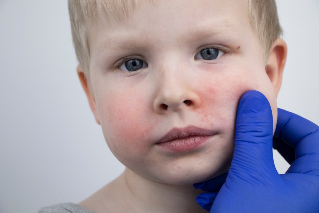 Herpes labial y nasal, ¿es la misma lesión? Un pediatra responde