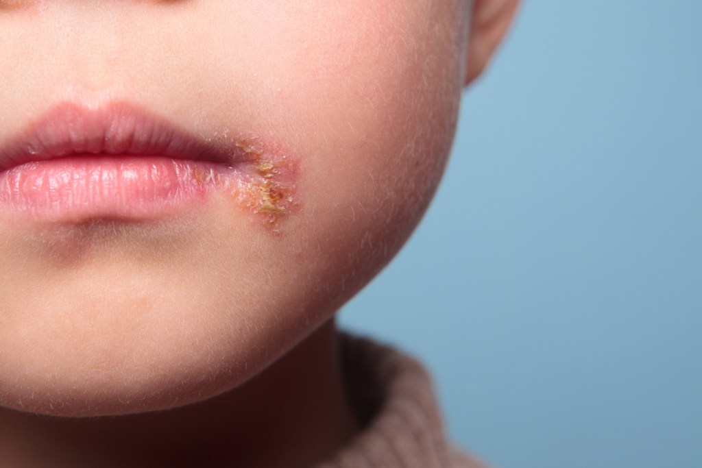 Herpes labial y nasal, ¿es la misma lesión? Un pediatra responde