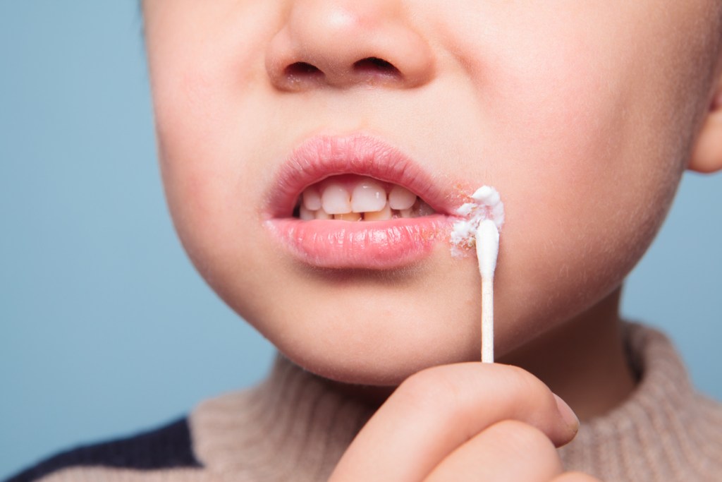 Herpes labial y nasal, ¿es la misma lesión? Un pediatra responde