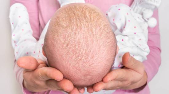 Mi bebé tiene caspa: ¿a qué se debe?