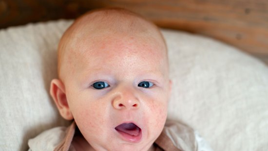 14 preguntas sobre dermatitis atópica
