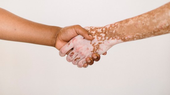 vitiligo