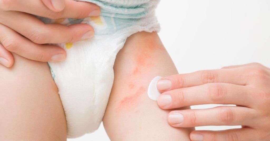 ¿Cómo calmar y prevenir la dermatitis del pañal del bebé?