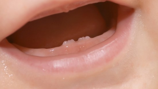 Muguet: qué es la candidiasis oral en niños