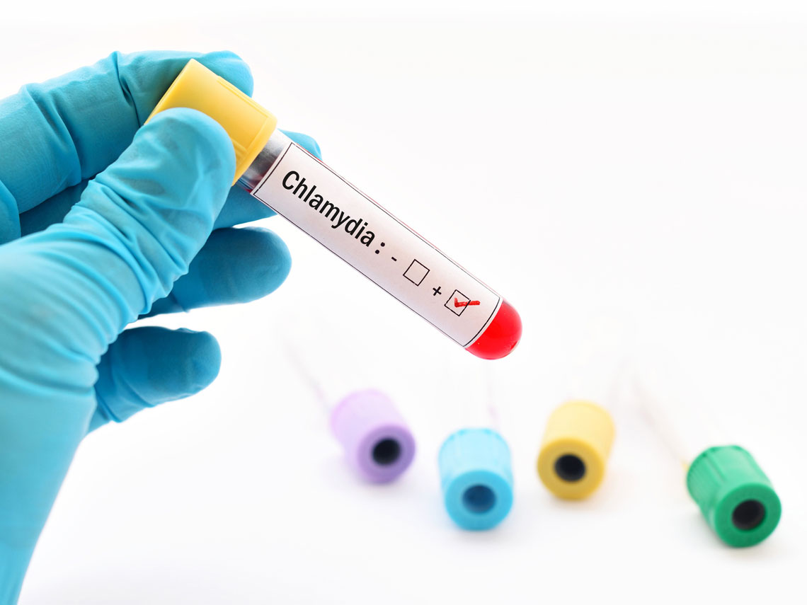 Clamidia: una causa de infertilidad