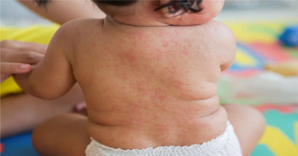 Roséola en bebés y niños pequeños: qué es, síntomas y tratamiento