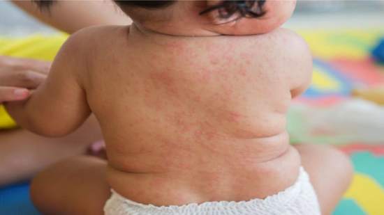 Roséola en bebés y niños pequeños: qué es, síntomas y tratamiento