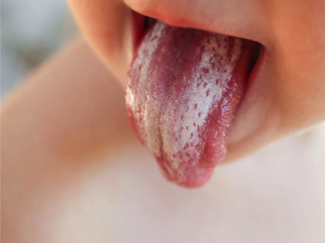 Lengua blanca del bebé