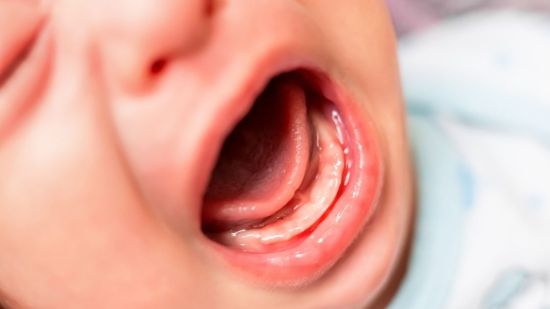 Problemas que puede causar el frenillo lingual, según la edad del niño