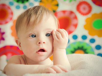La bronquiolitis en niños con síndrome de Down