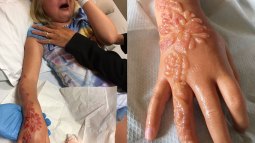 ¡Cuidado con los tatuajes de henna en los niños!