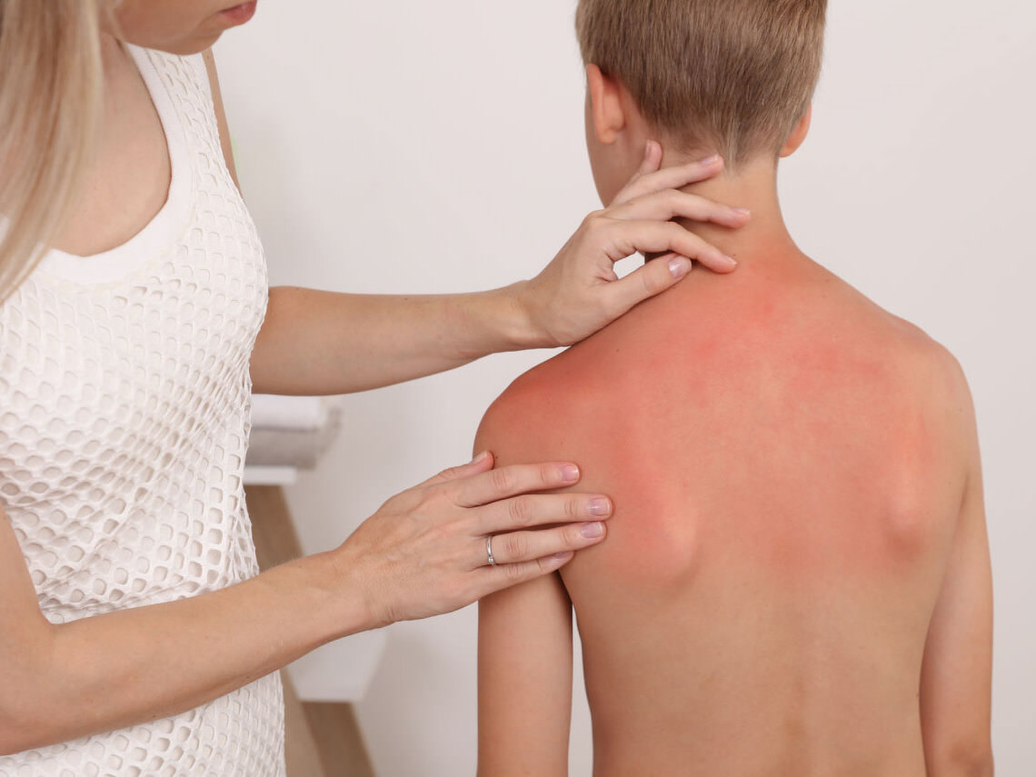 10 remedios naturales para las quemaduras solares