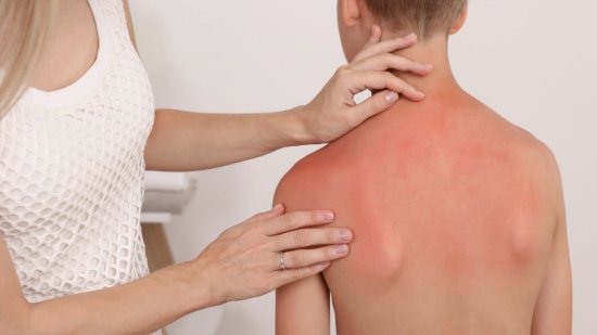 10 remedios naturales para las quemaduras solares