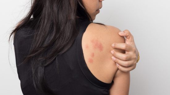 Urticaria en el embarazo: causas, tratamiento y cómo aliviarla