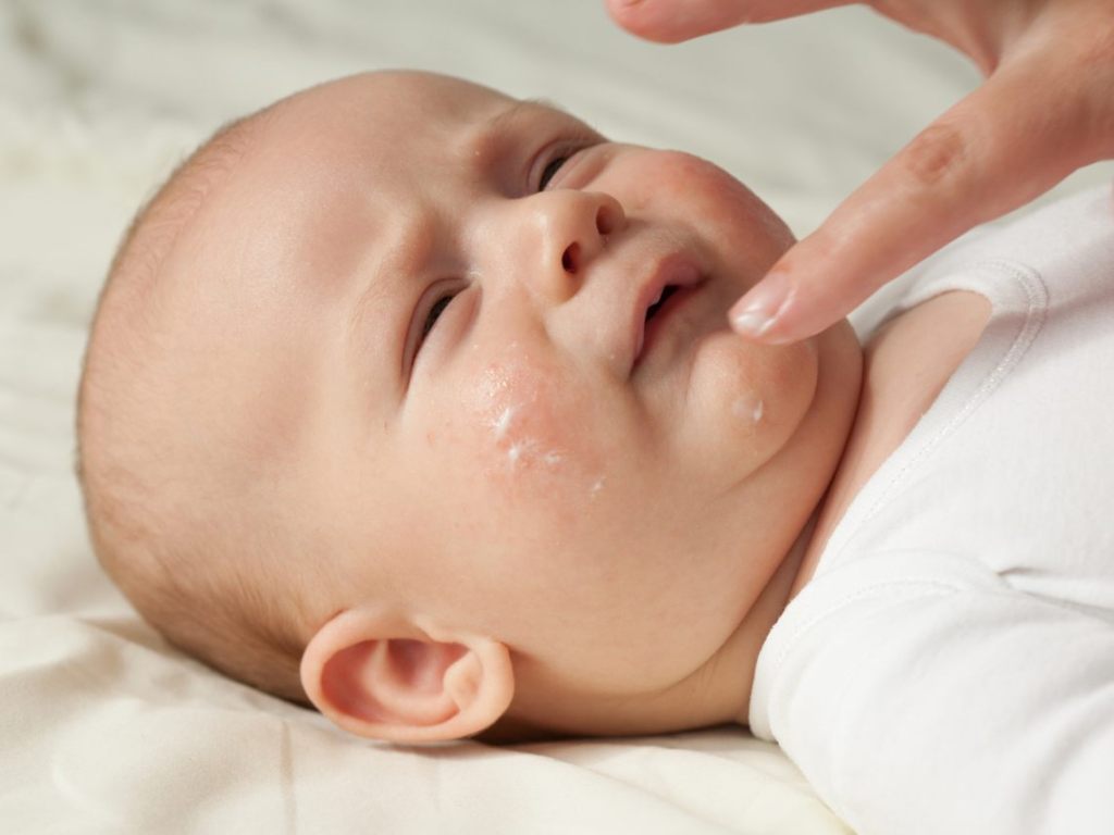 Mi peque tiene dermatitis atópica