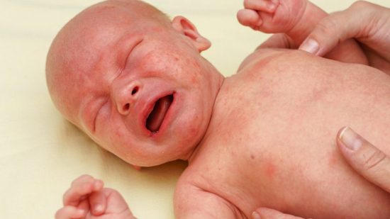 Petequias en el bebé: causas, síntomas y tratamiento