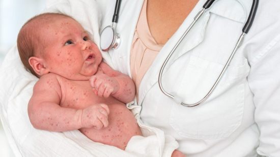 Herpes en bebés: ¿por qué se producen y cómo tratarlos?