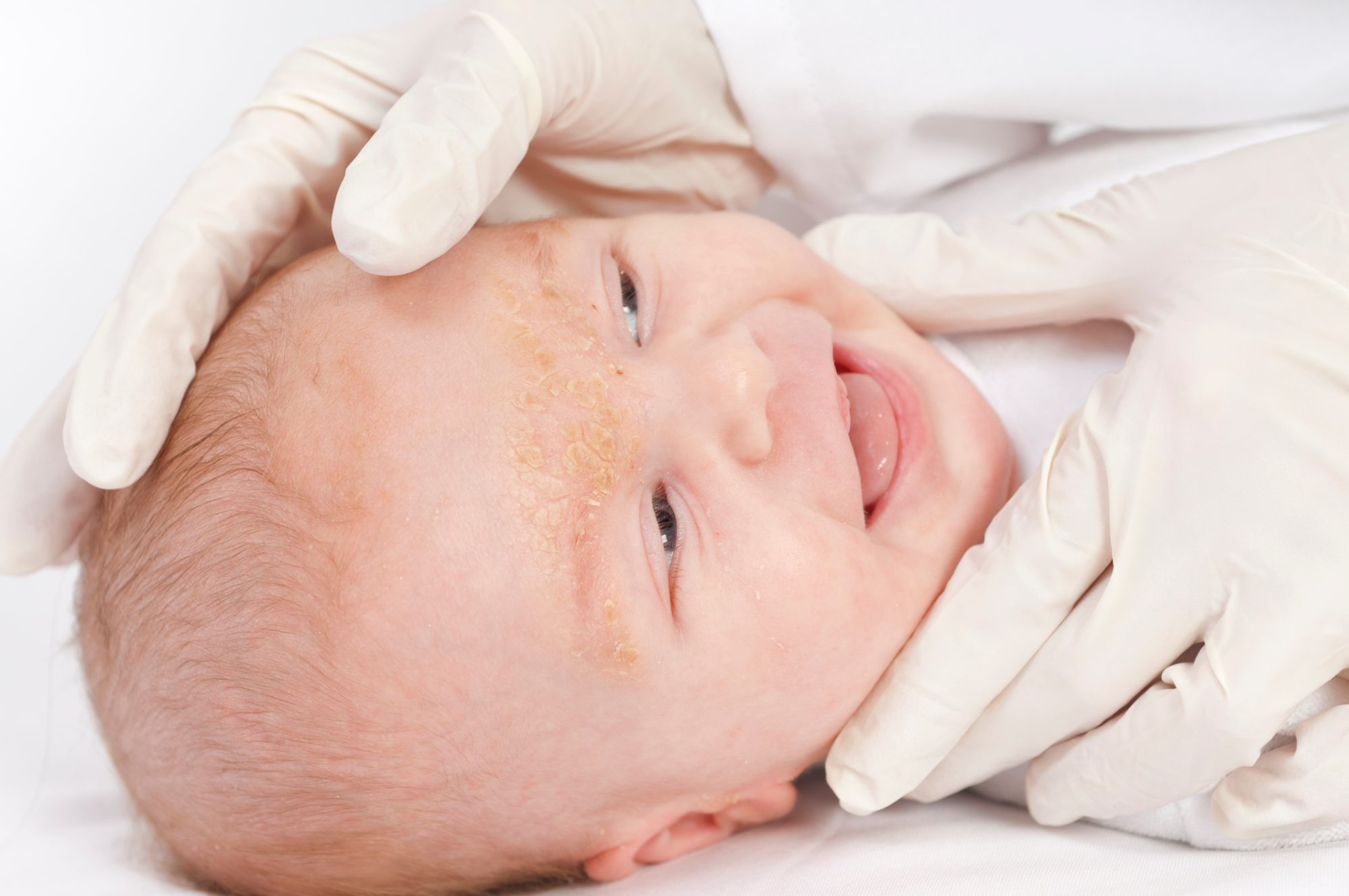 Dermatitis seborreica del bebé