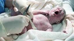 Prolapso de cordón umbilical: causas y riesgos