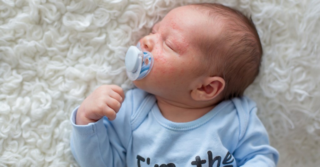 ¿Qué es el acné neonatal y por qué se produce?