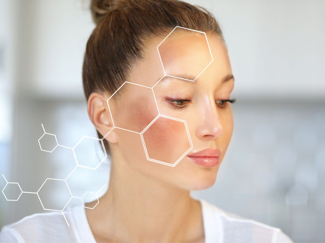 Melasma