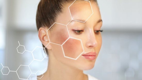 Melasma
