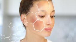 Melasma