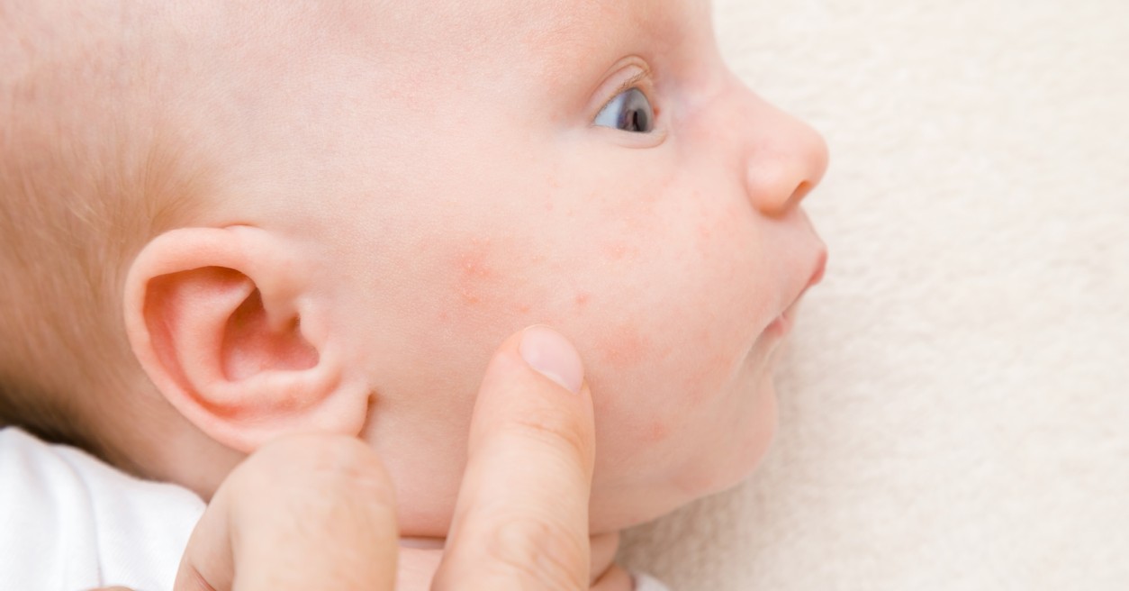 Urticaria en bebés, ¿por qué aparece y cómo debemos tratarla?