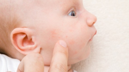 Urticaria en bebés, ¿por qué aparece y cómo debemos tratarla?