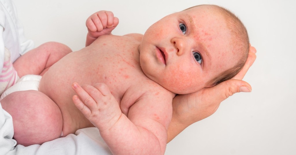 Granos en bebés: ¿por qué se producen?