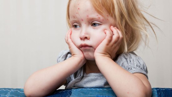 niña con varicela