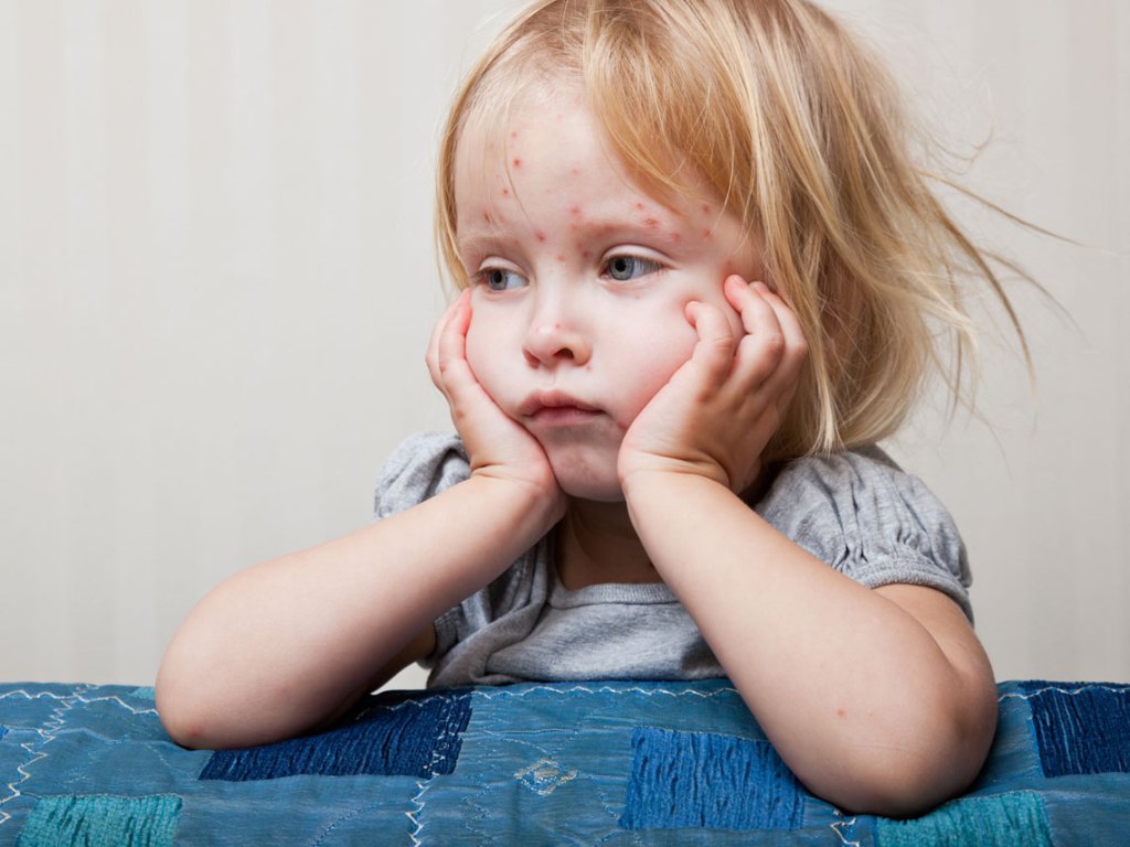 niña con varicela