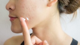 Acné en adolescentes