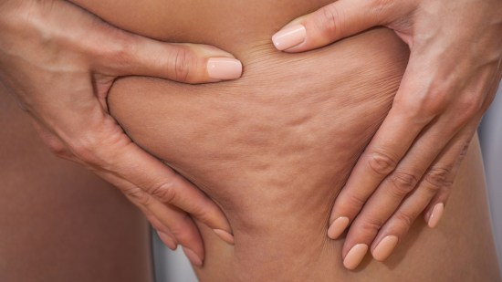 Celulitis