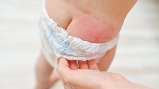 Granitos en las nalgas de bebés y niños: ¿por qué aparecen?