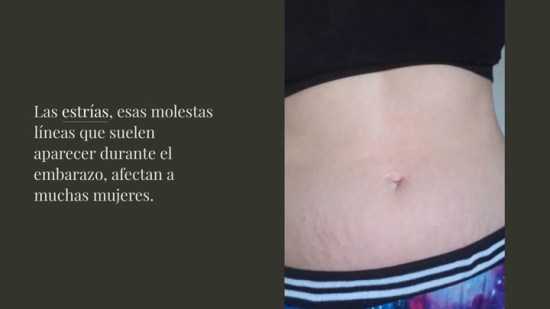 ¿La leche materna puede ayudar a reducir las estrías? Beneficios y cómo usarla