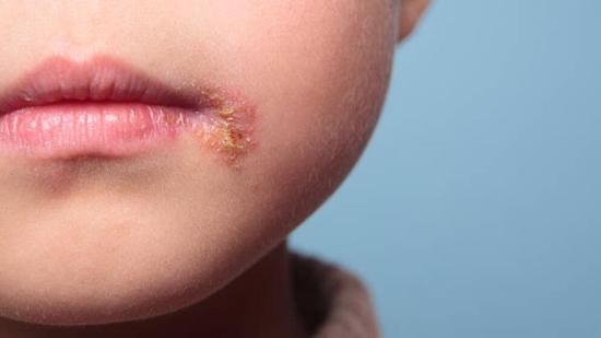 herpes-labial-en-ninos