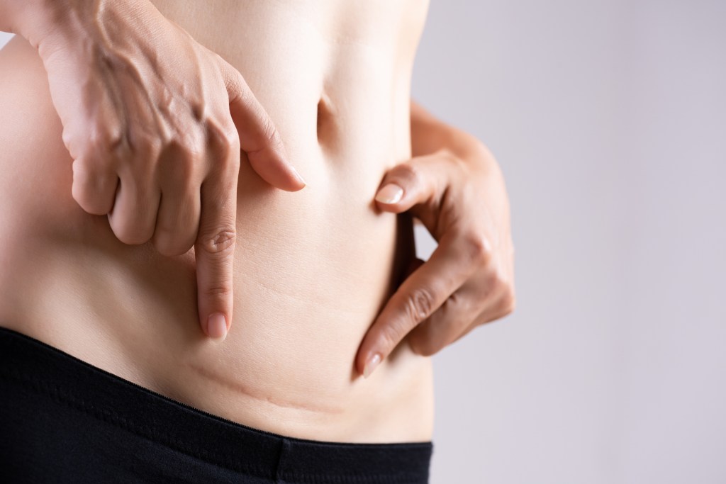 7 cosas que no sabías de las cicatrices por cesárea
