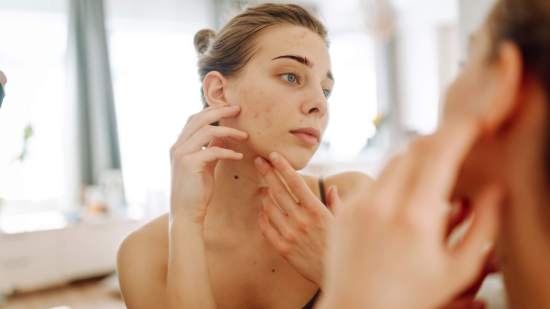 Los consejos de un dermatólogo para tratar el acné en el postparto y recuperar tu piel