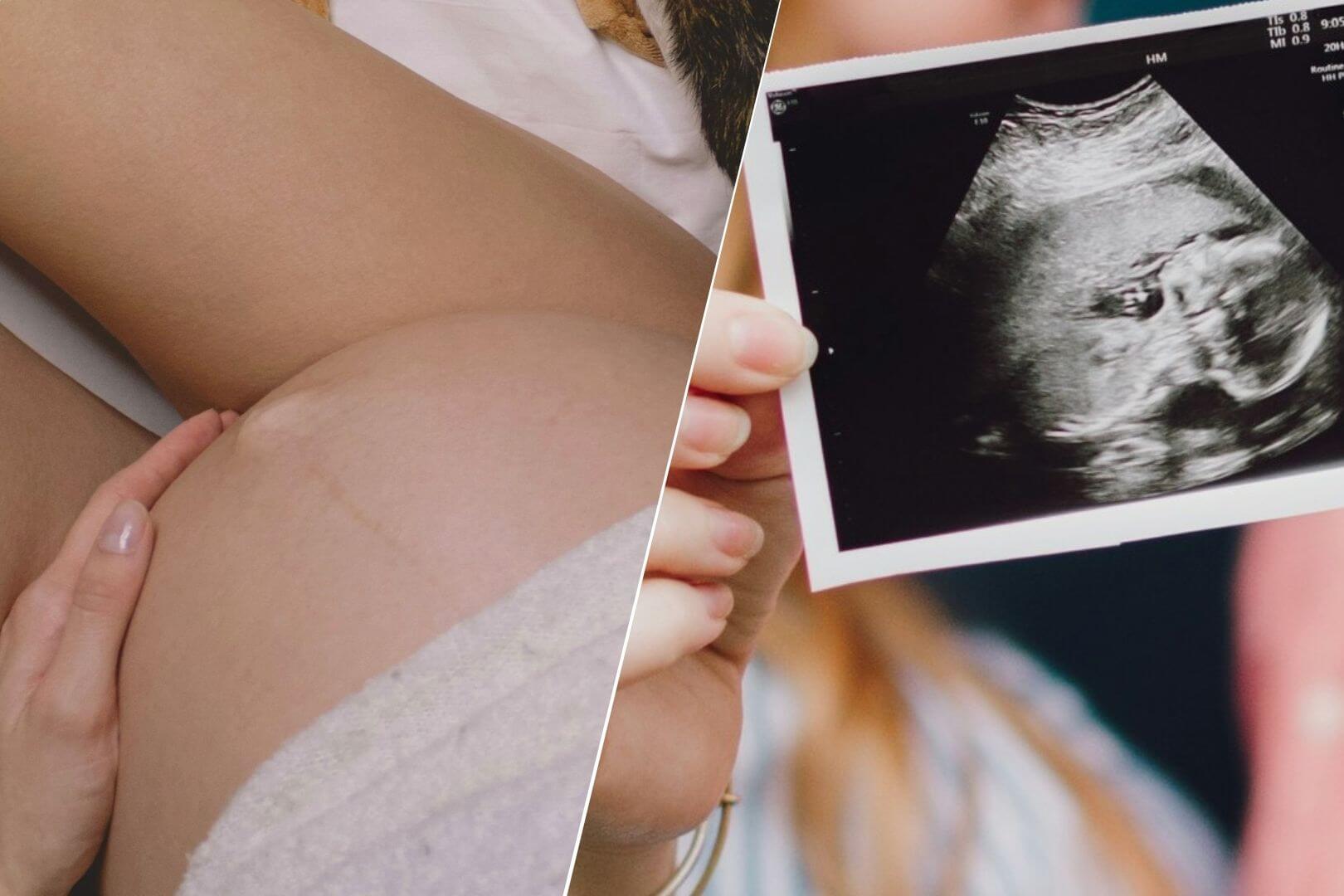 Endometriosis y fertilidad