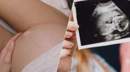 Endometriosis y fertilidad