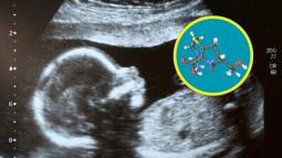 La historia detrás del primer uso prenatal de un medicamento para la atrofia muscular espinal
