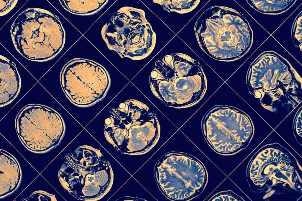 El estudio reveló que ciertas modificaciones epigenéticas en el ADN de la placenta están vinculadas al riesgo de desarrollar esquizofrenia, lo que sugiere que el trastorno podría empezar a gestarse incluso antes del nacimiento